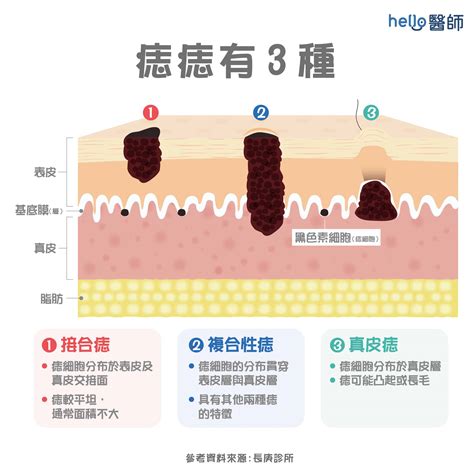 長痣原因|痣形成的原因？痣長毛、痣變多變大是痣病變？5招判。